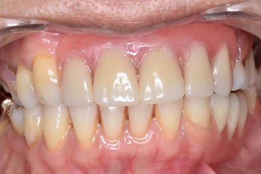 restored upper front teeth after cosmetic dental treatment Upland